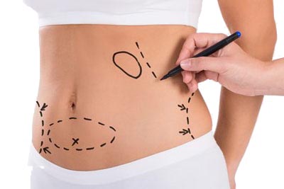 AWAKE Liposuction